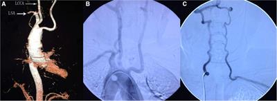 Subclavian steal syndrome associated with right aortic arch: A case report